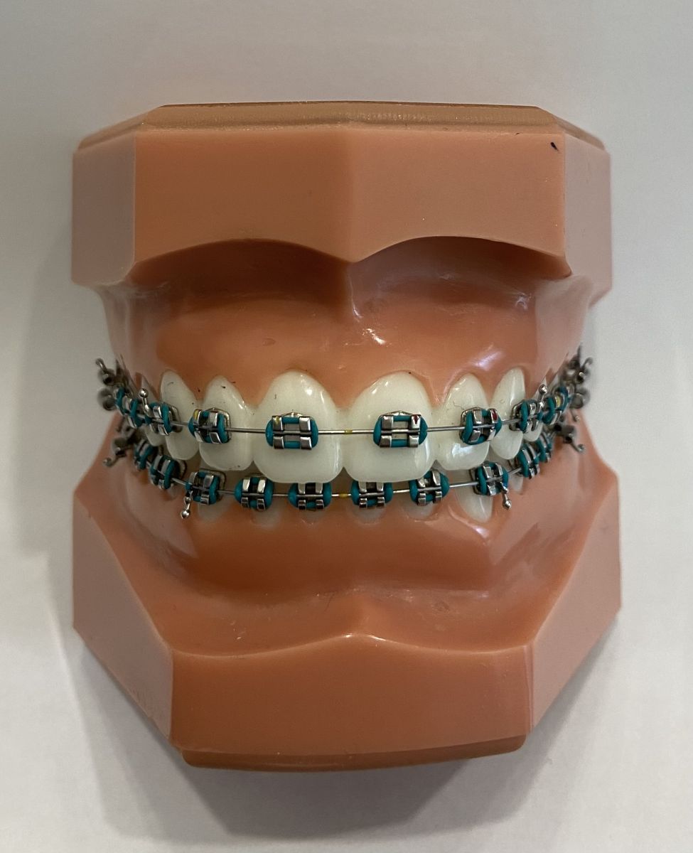 Types of Braces - Braces in Markham